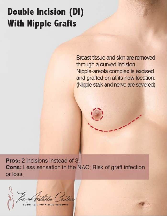 FTM Top Surgery Newport Beach￼