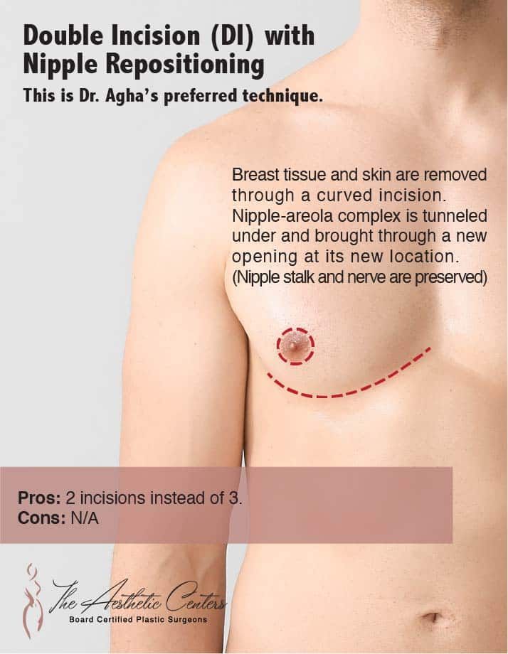 Double incision technique with nipple repositioning explanation.