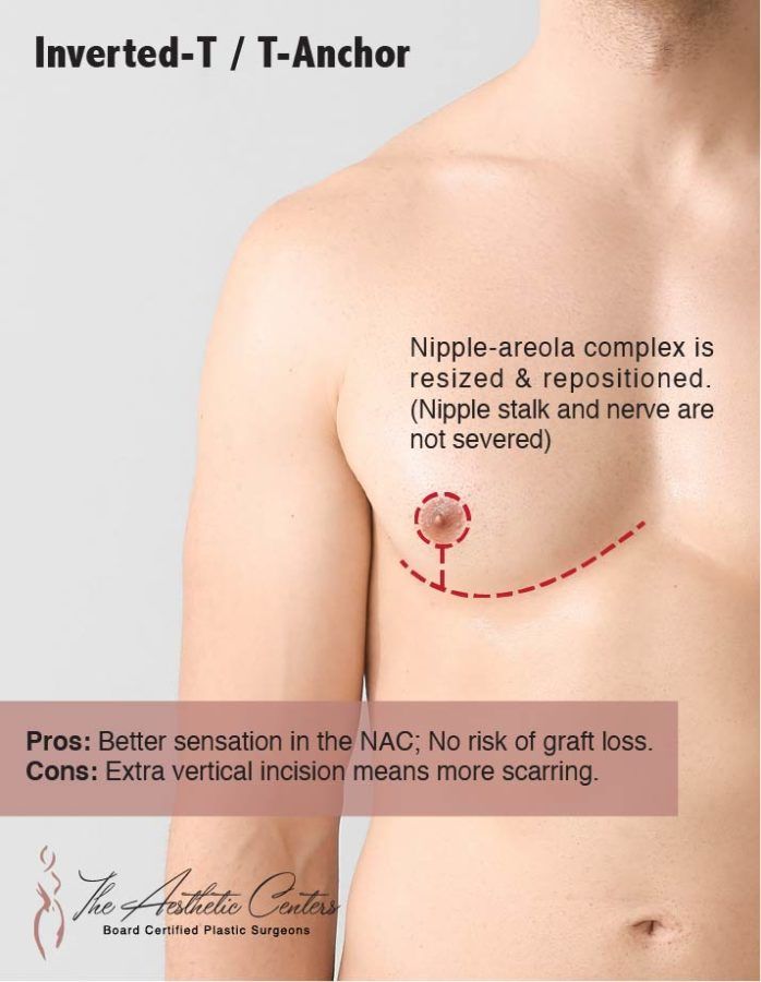 FTM Top Surgery Newport Beach￼