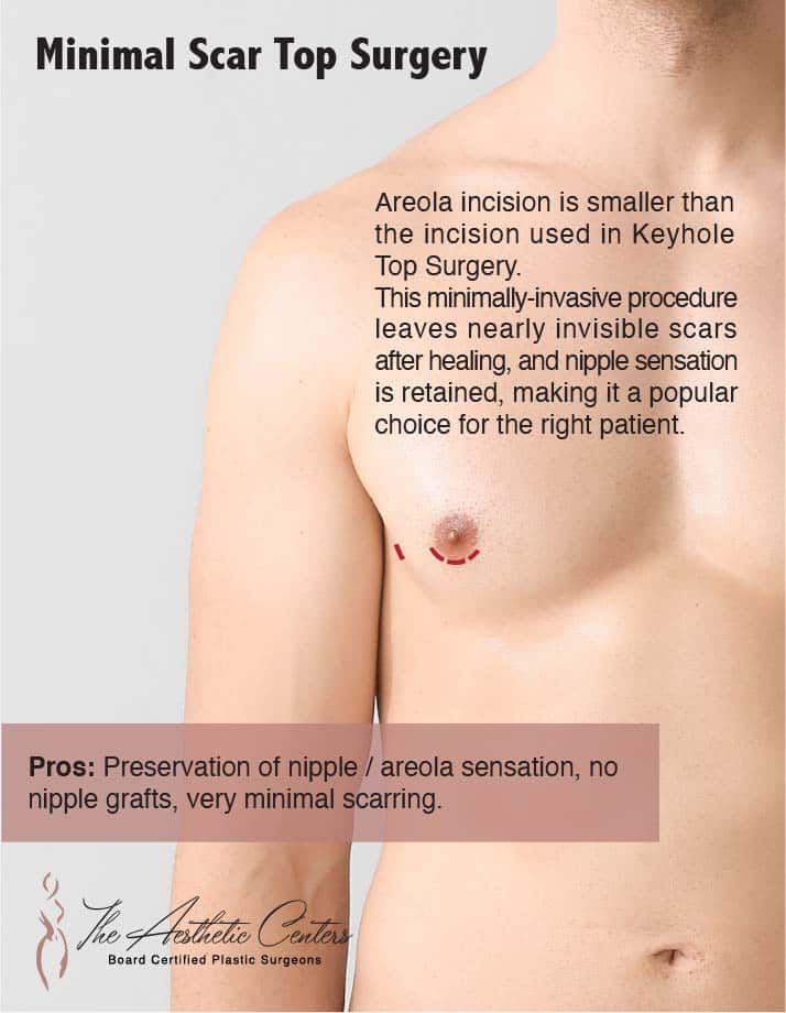 Minimal scar top surgery benefits and technique overview.