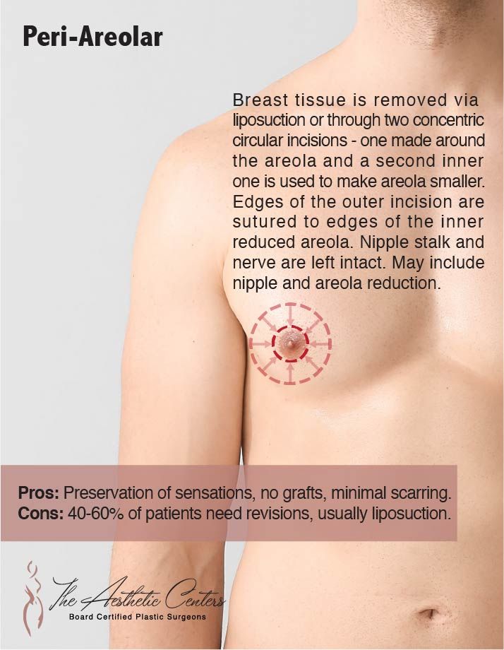 Peri-areolar breast tissue reduction explanation image.