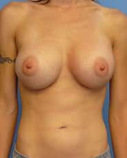 Secondary Breast Augmentation Newport Beach