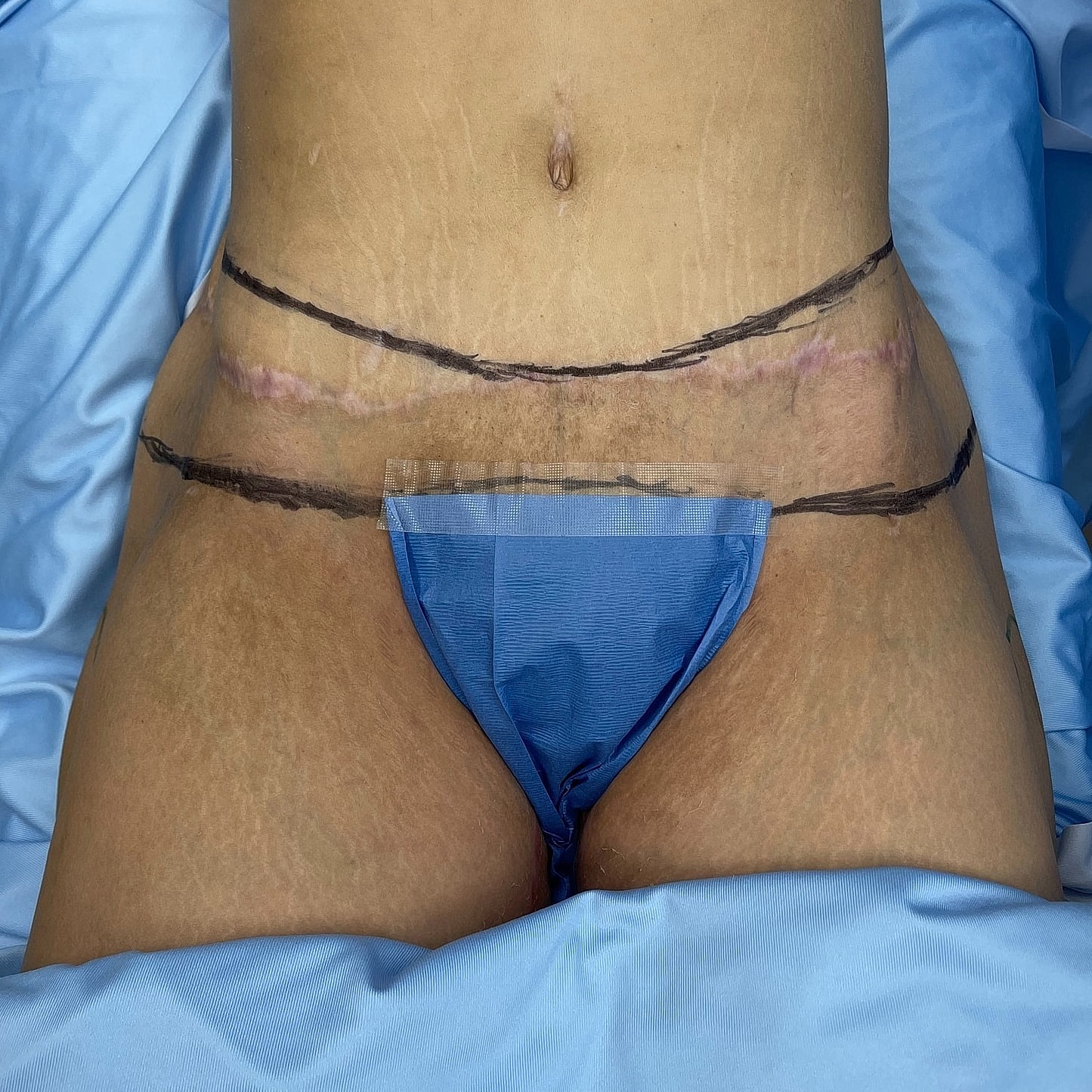 Surgical site on lower abdomen, blue surgical drape.