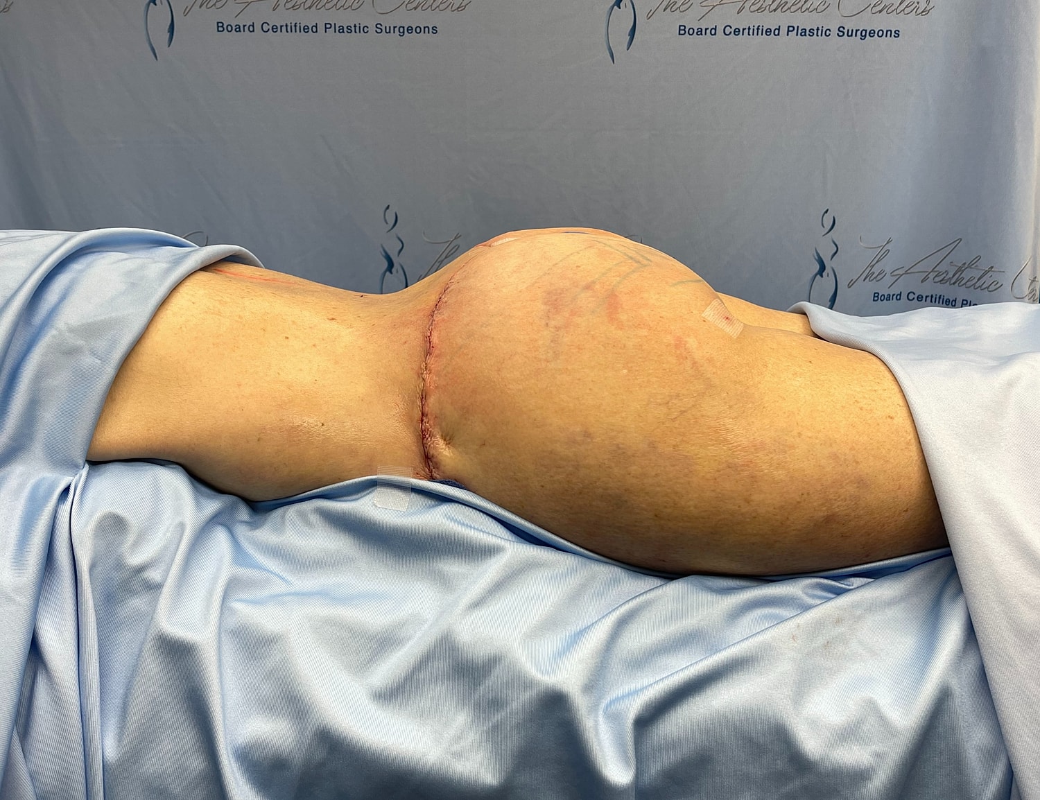 Post-surgery body with visible incision line.