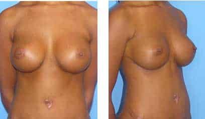 Secondary Breast Augmentation Newport Beach