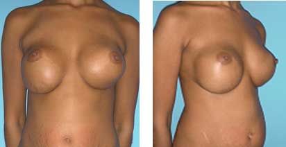Secondary Breast Augmentation Newport Beach
