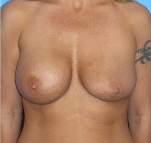 Secondary Breast Augmentation Newport Beach