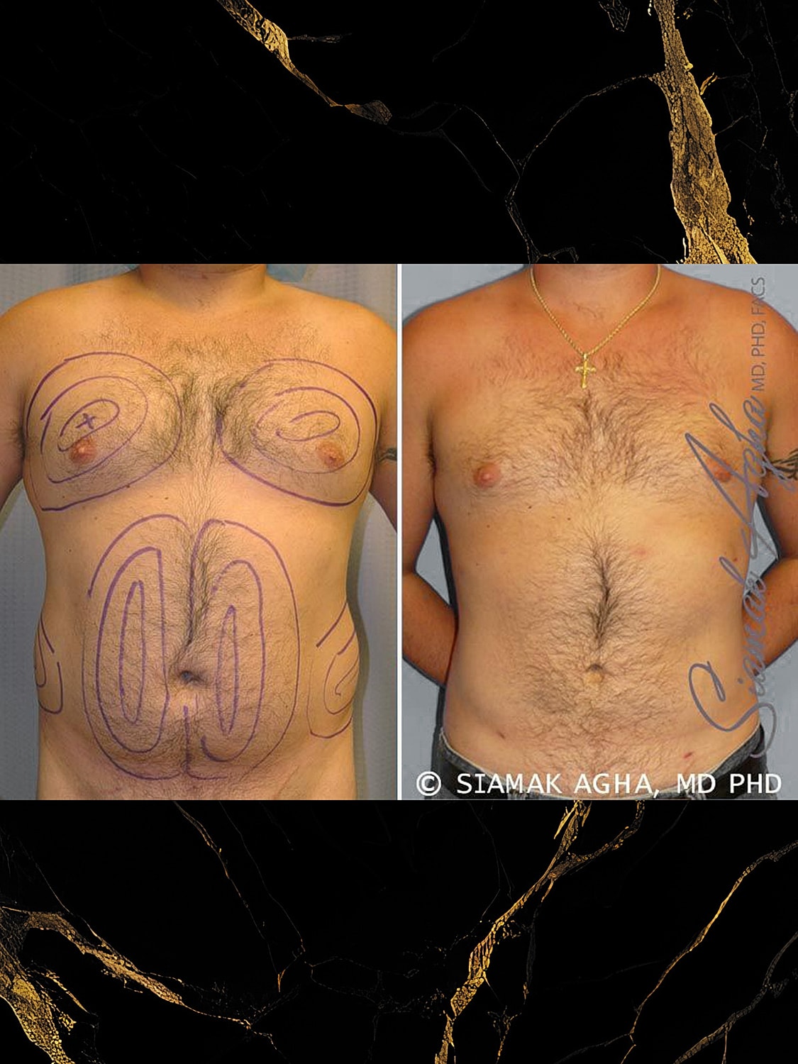 Before and after male body contouring procedure.