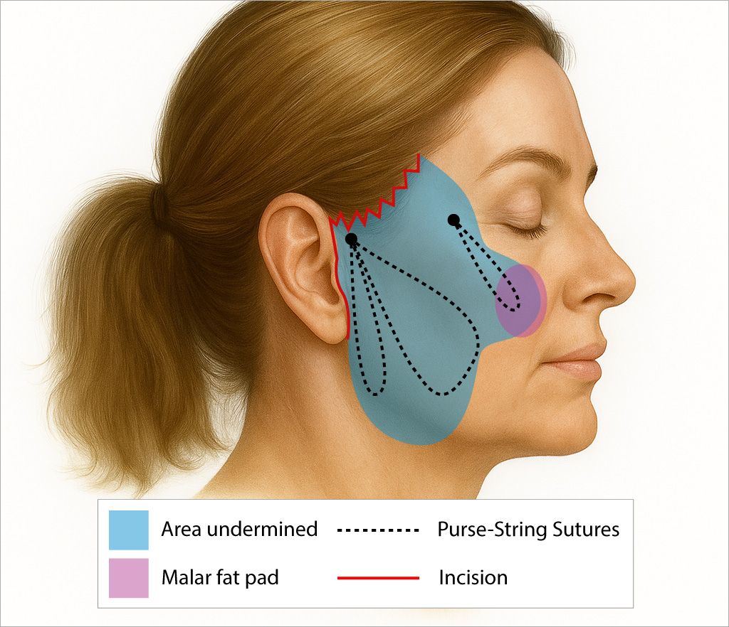 Facial anatomy illustration with surgical details labeled.