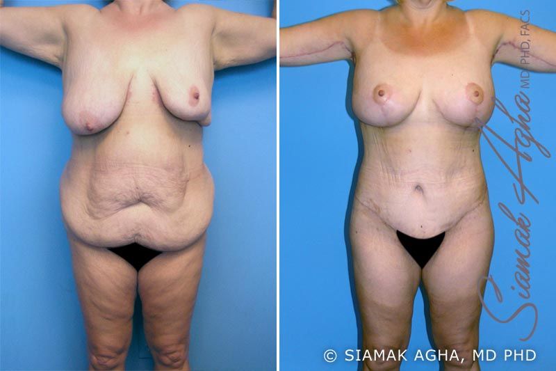 Breast Enhancement