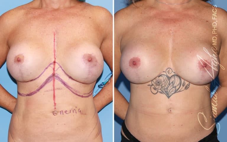 Before and after tattoo on breast area.