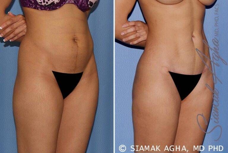 Before and after body contouring results