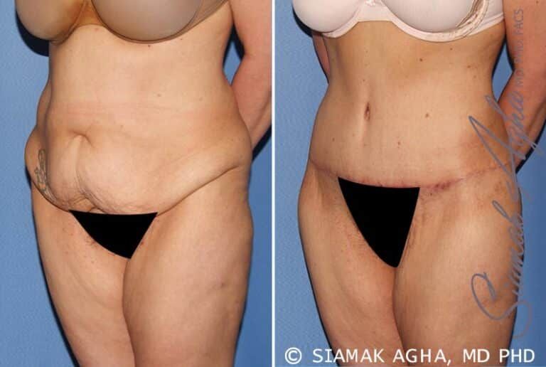 Before and after body contouring surgery.