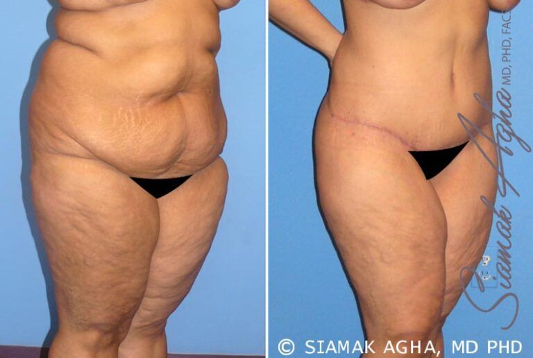 Before and after body contouring transformation.