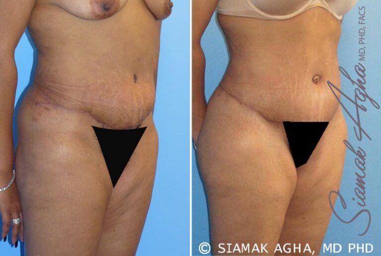 Before and after body transformation photo.