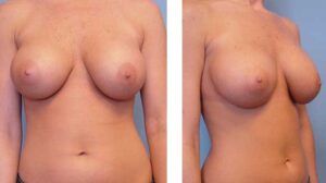 Secondary Breast Augmentation Newport Beach