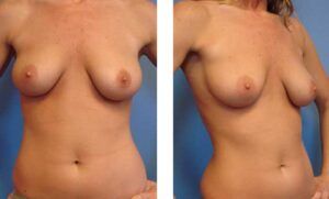 Secondary Breast Augmentation Newport Beach