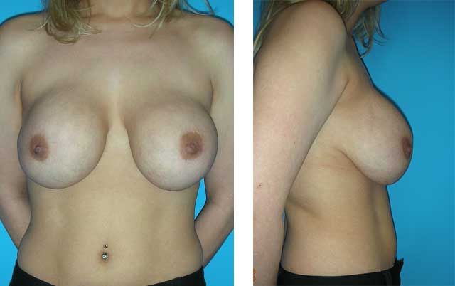 Secondary Breast Augmentation Newport Beach