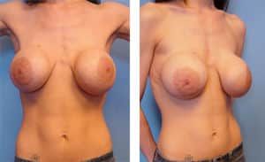 Secondary Breast Augmentation Newport Beach