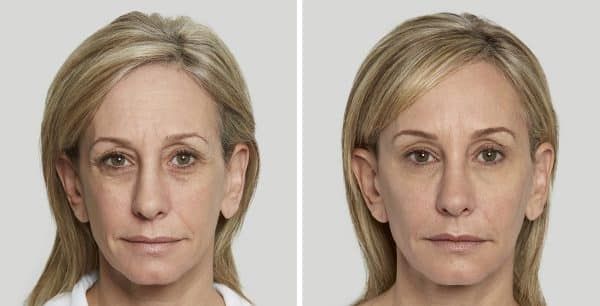 Before and after facial rejuvenation comparison.