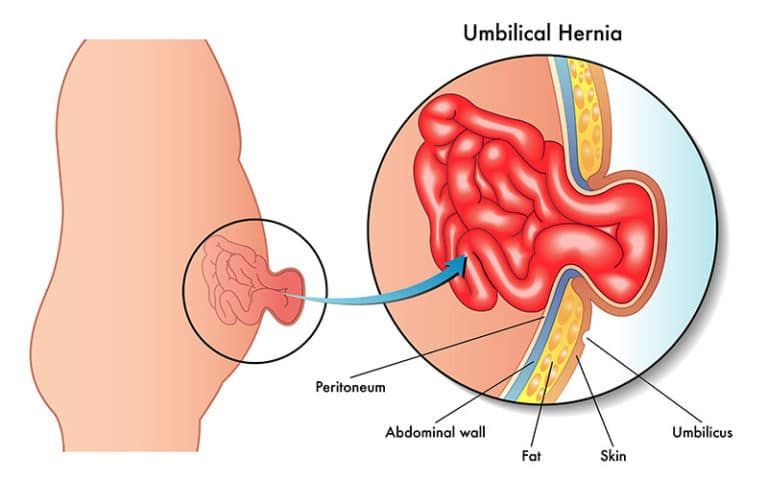 Diagram of an umbilical hernia anatomy.