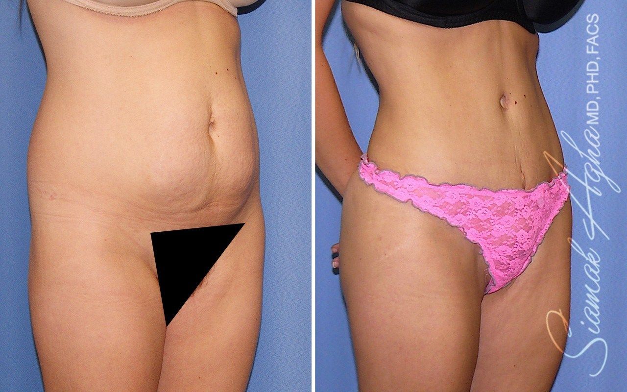 Combined Tummy Tuck Brazilian Butt Lift Before & After