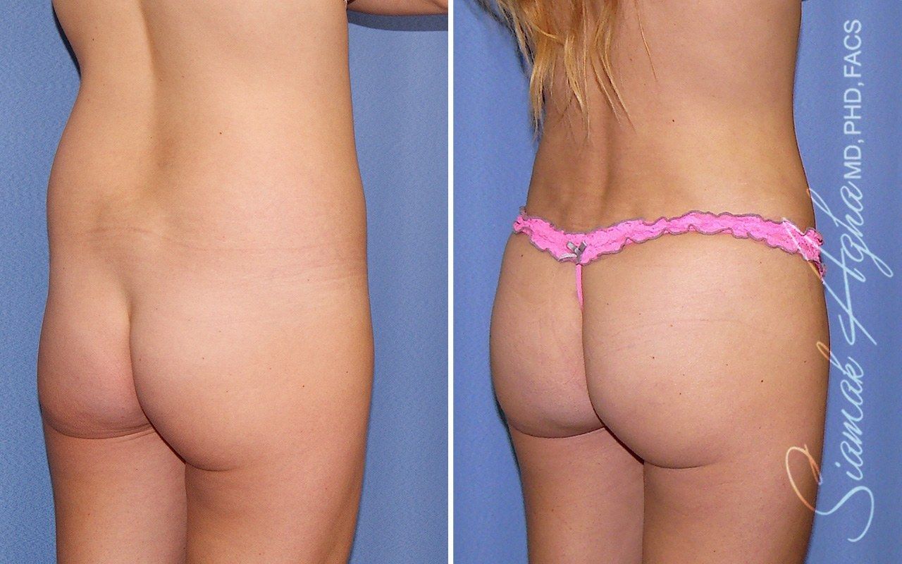 Combined Tummy Tuck Brazilian Butt Lift Before & After