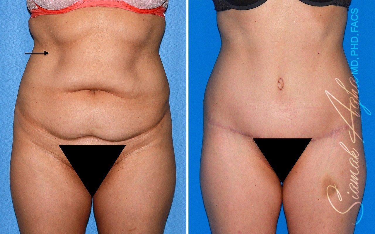 Combined Tummy Tuck Brazilian Butt Lift Before & After