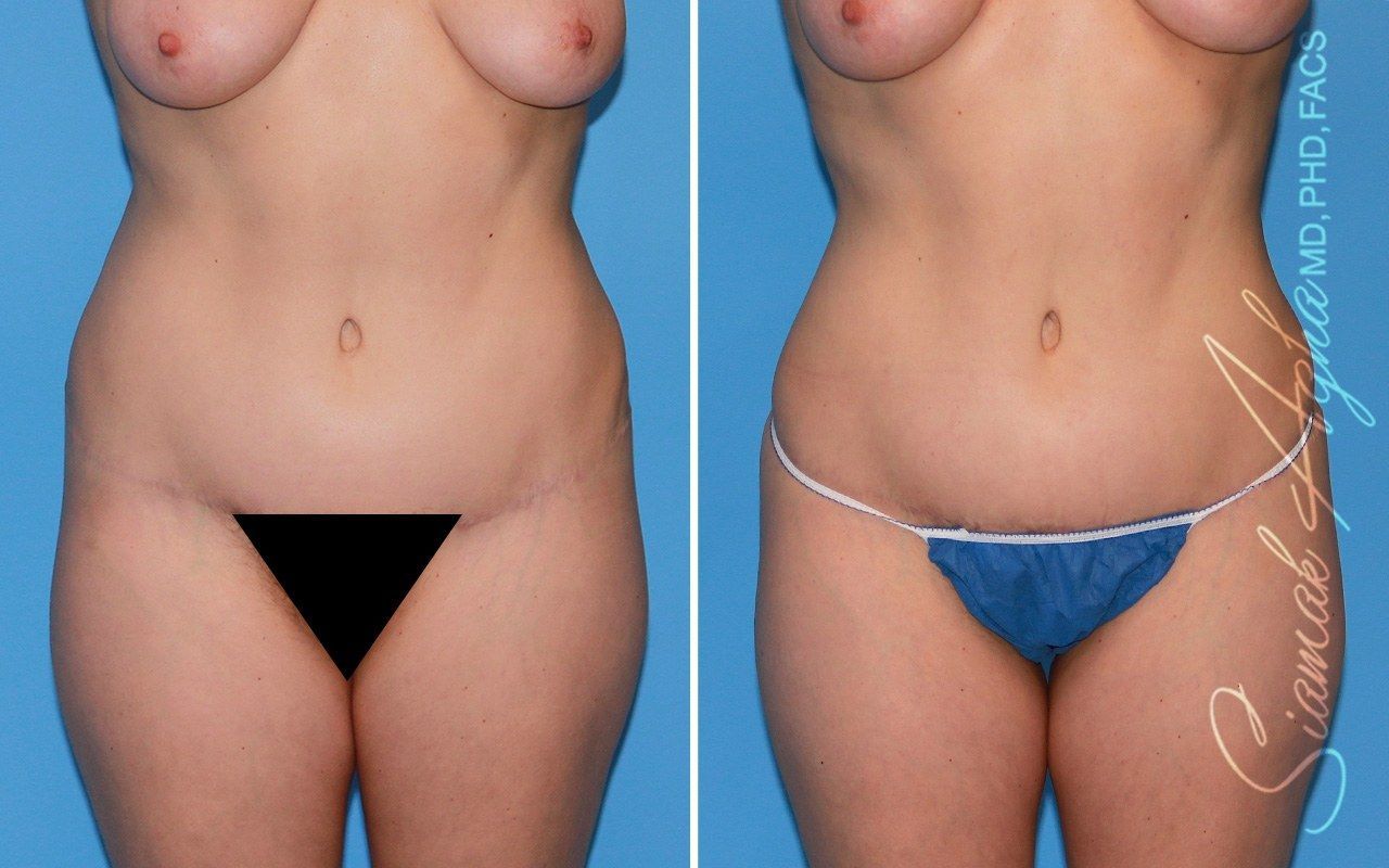 Combined Tummy Tuck Brazilian Butt Lift Before & After