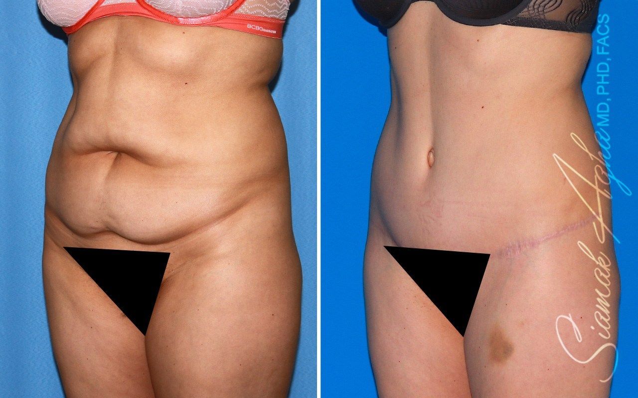 Combined Tummy Tuck Brazilian Butt Lift Before & After