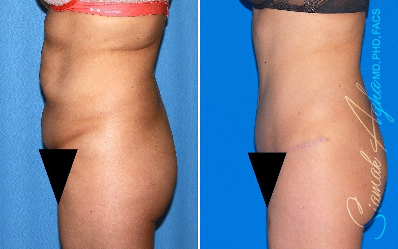 Combined Tummy Tuck Brazilian Butt Lift Before & After
