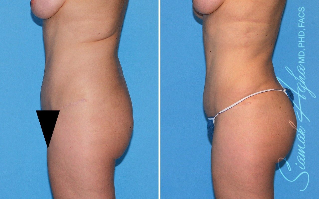 Combined Tummy Tuck Brazilian Butt Lift Before & After