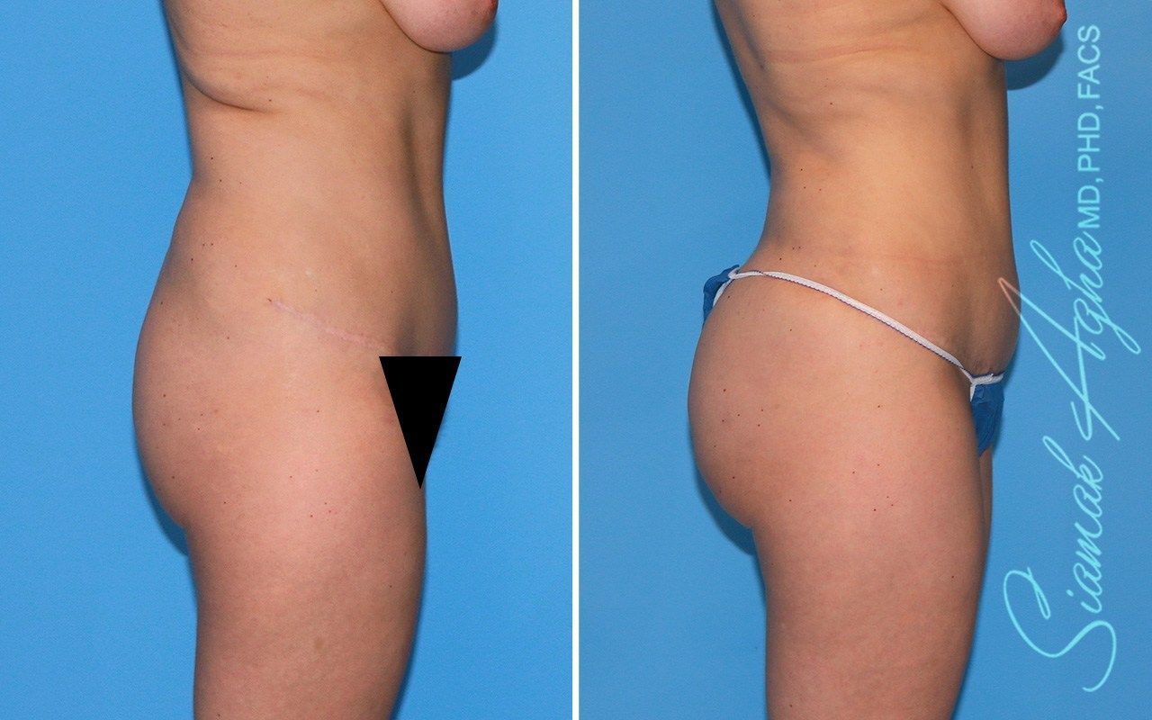 Combined Tummy Tuck Brazilian Butt Lift Before & After