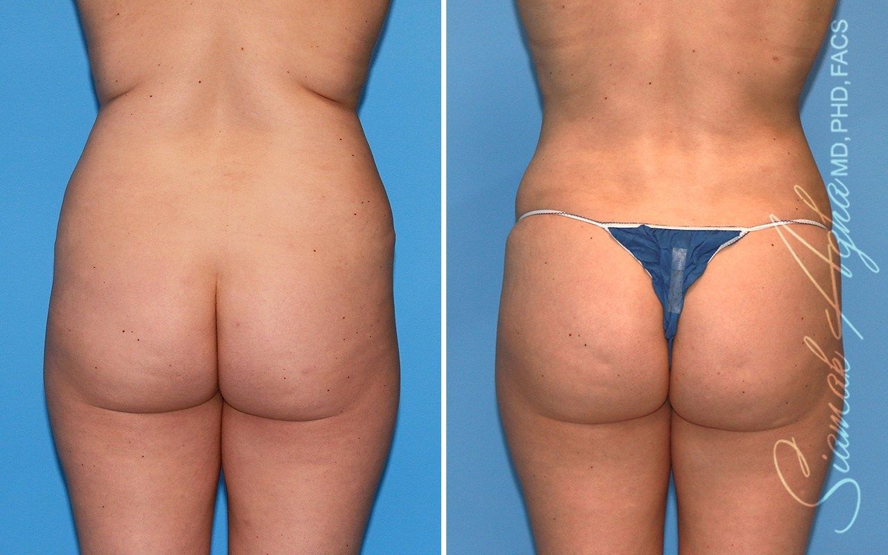 Combined Tummy Tuck Brazilian Butt Lift Before & After