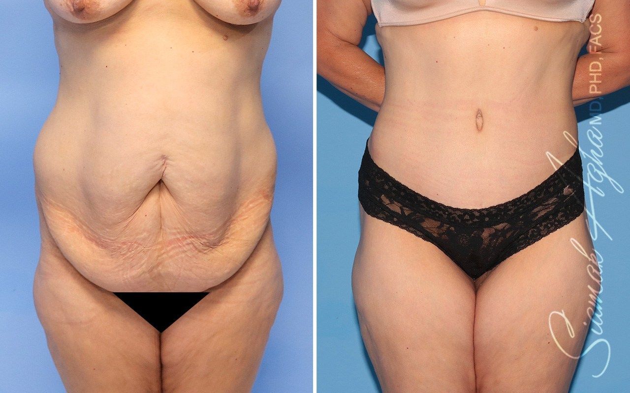 Combined Tummy Tuck Brazilian Butt Lift Before & After