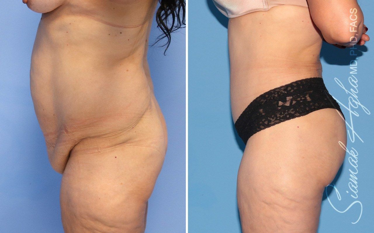 Combined Tummy Tuck Brazilian Butt Lift Before & After