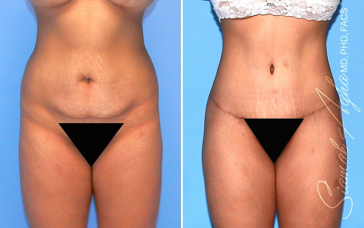 Combined Tummy Tuck Brazilian Butt Lift Before & After
