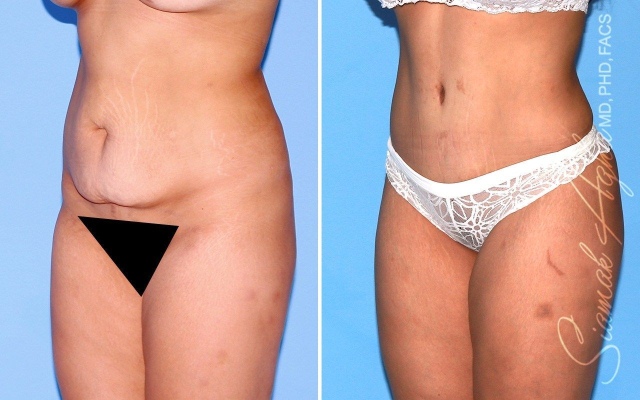 Combined Tummy Tuck Brazilian Butt Lift Before & After