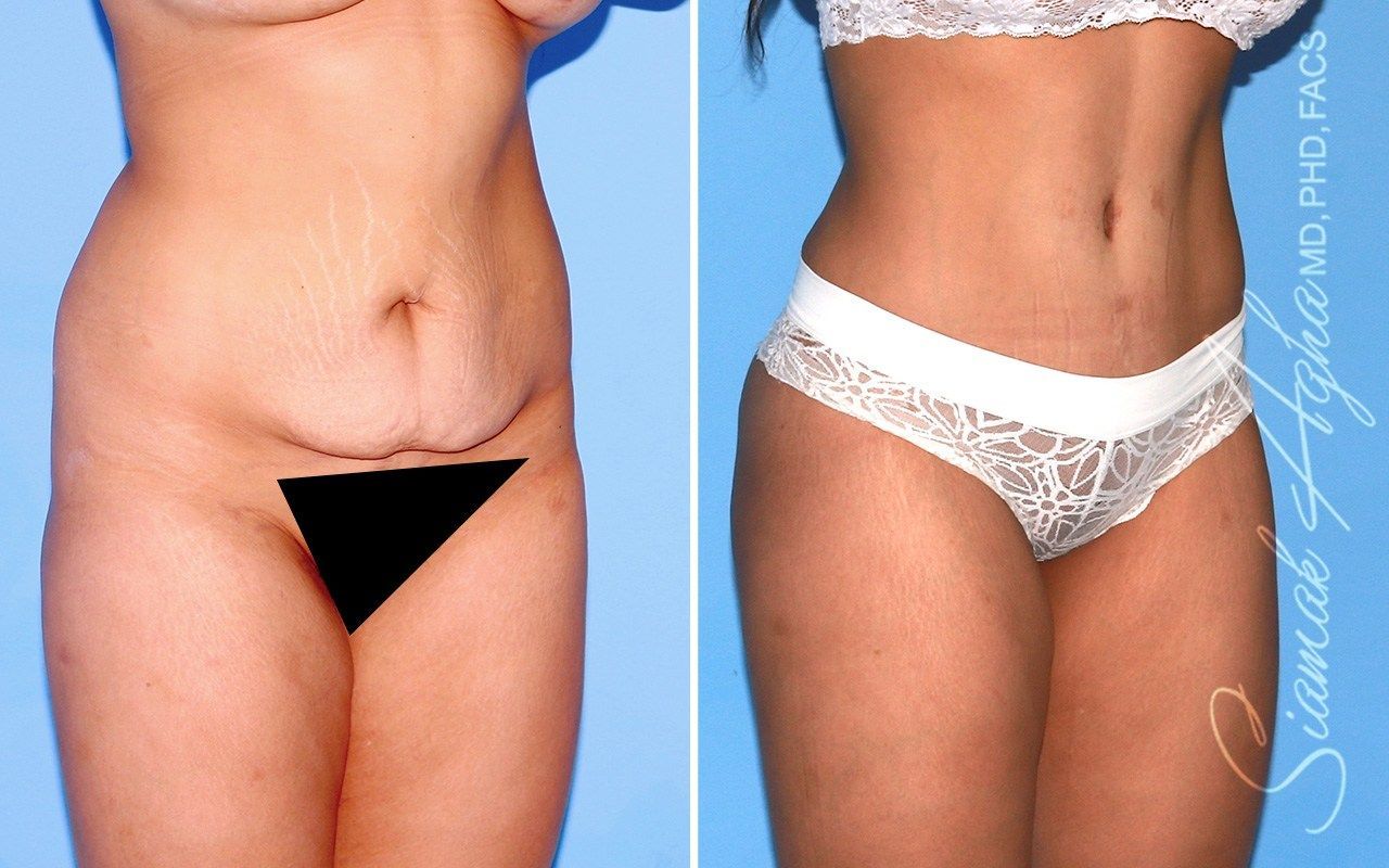 Combined Tummy Tuck Brazilian Butt Lift Before & After
