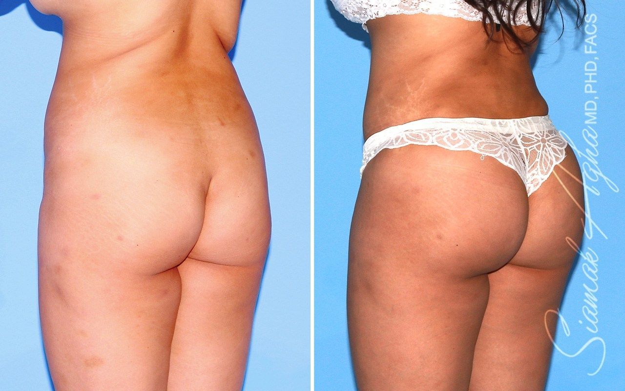 Combined Tummy Tuck Brazilian Butt Lift Before & After