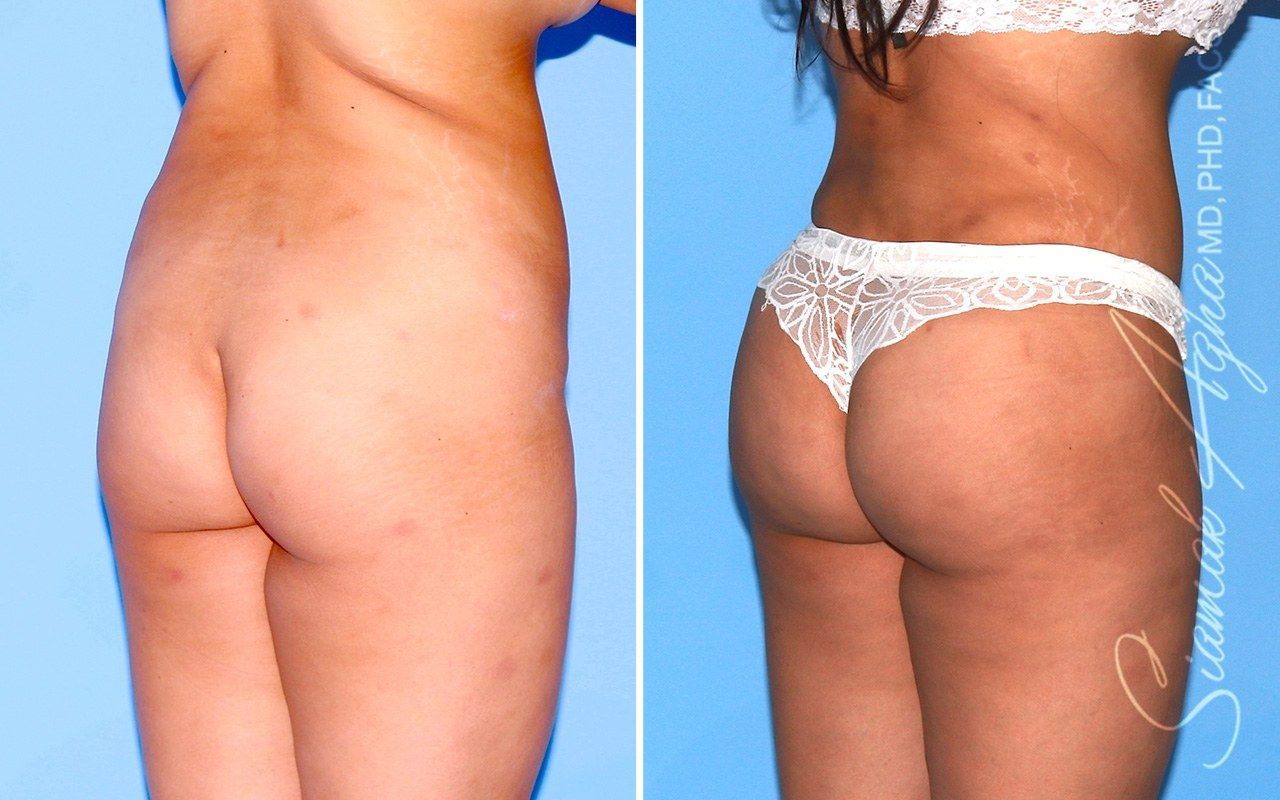 Combined Tummy Tuck Brazilian Butt Lift Before & After