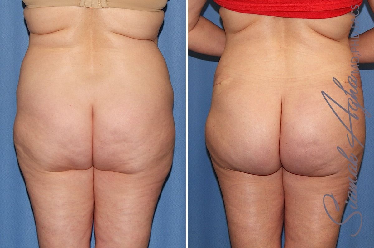 Combined Tummy Tuck Brazilian Butt Lift Before & After