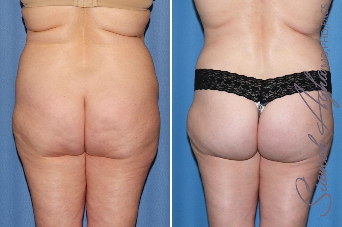 Combined Tummy Tuck Brazilian Butt Lift Before & After