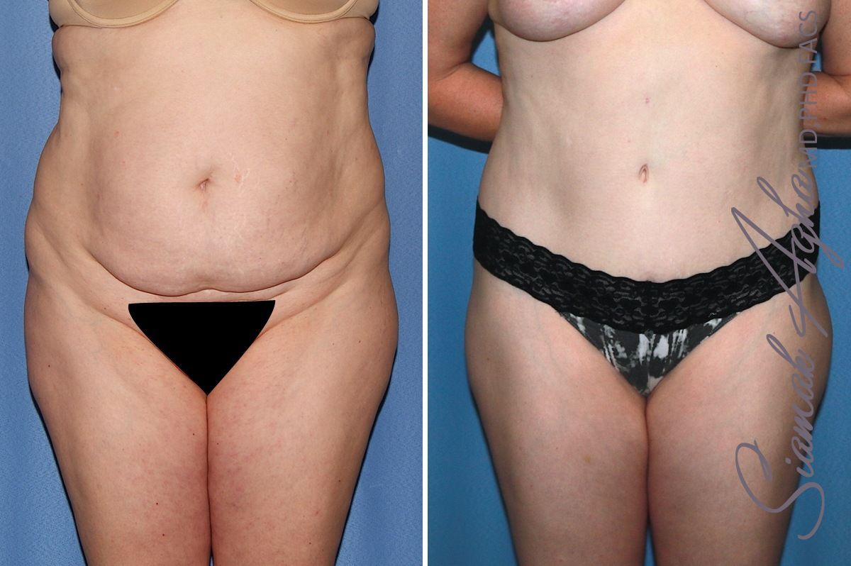 Combined Tummy Tuck Brazilian Butt Lift Before & After