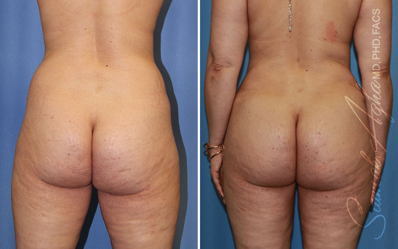 Combined Tummy Tuck Brazilian Butt Lift Before & After
