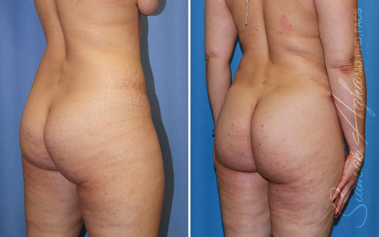 Combined Tummy Tuck Brazilian Butt Lift Before & After