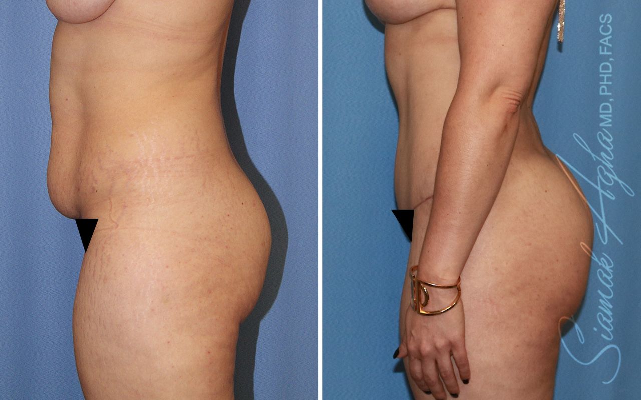 Combined Tummy Tuck Brazilian Butt Lift Before & After