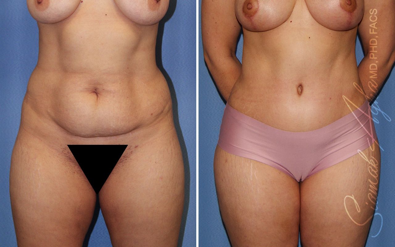 Combined Tummy Tuck Brazilian Butt Lift Before & After