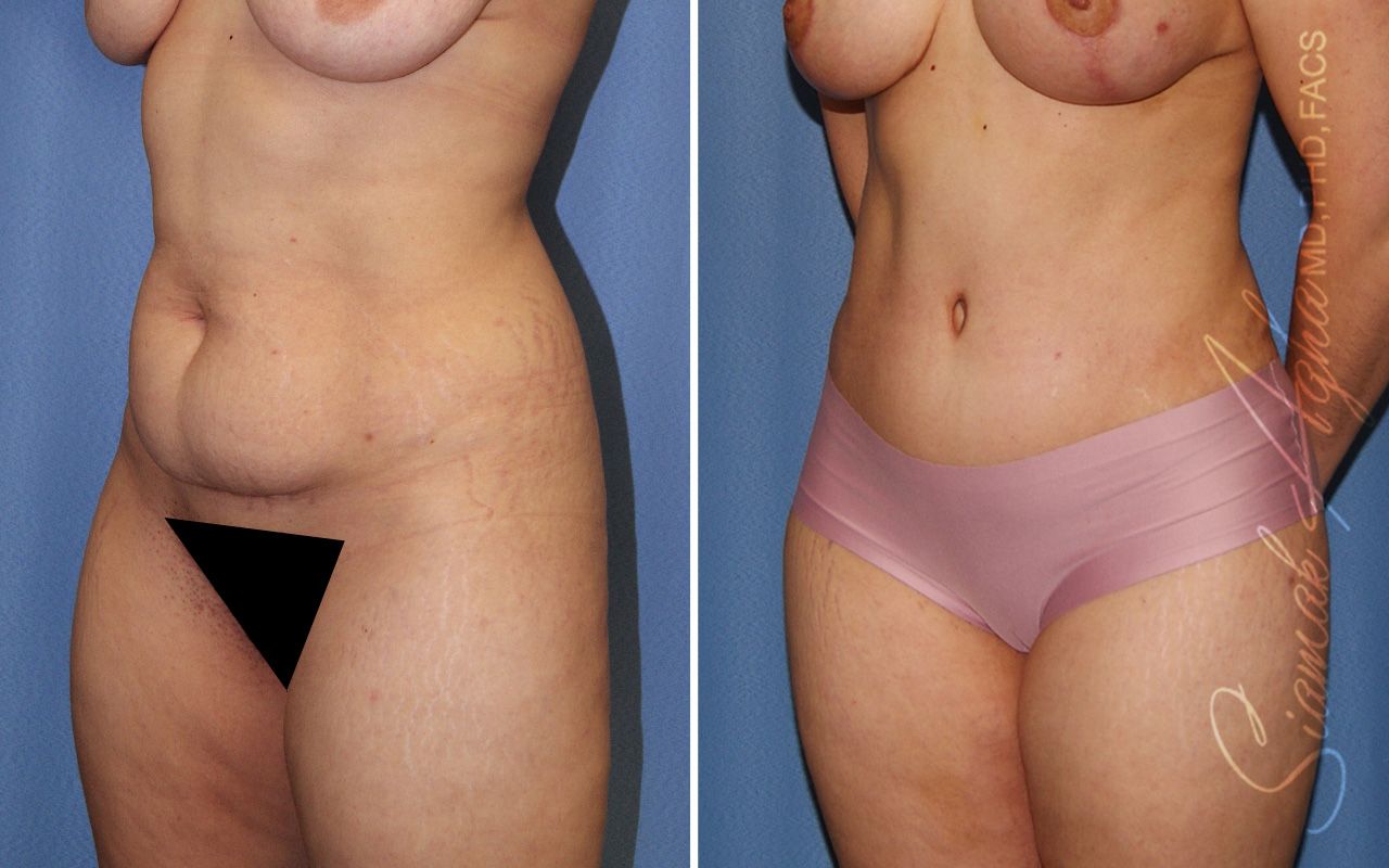 Combined Tummy Tuck Brazilian Butt Lift Before & After