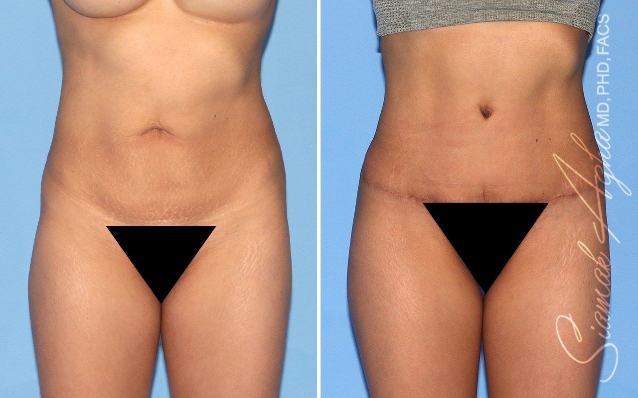 Combined Tummy Tuck Brazilian Butt Lift Before & After